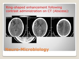 Neuro-Microbiology
Ring-shaped enhancement following
contrast administration on CT (Abscess):
 