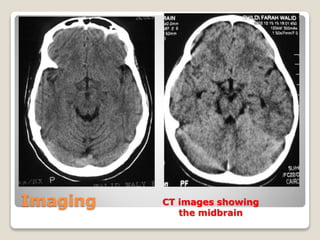 Imaging CT images showing
the midbrain
 