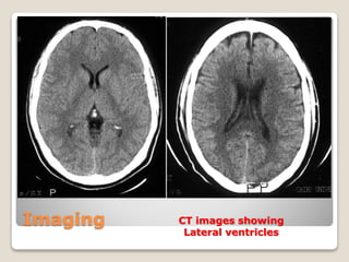 Imaging CT images showing
Lateral ventricles
 