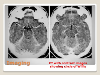 Imaging CT with contrast images
showing circle of Willis
 