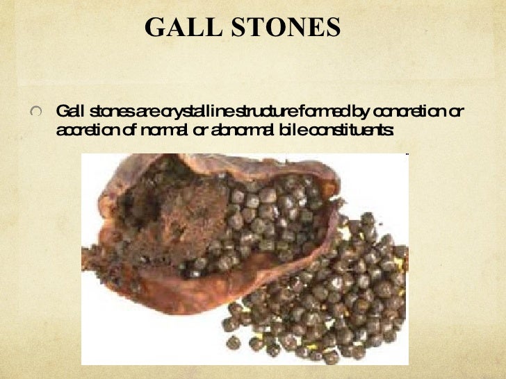 Image result for Liver stones images