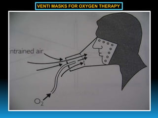 VENTI MASKS FOR OXYGEN THERAPY
 