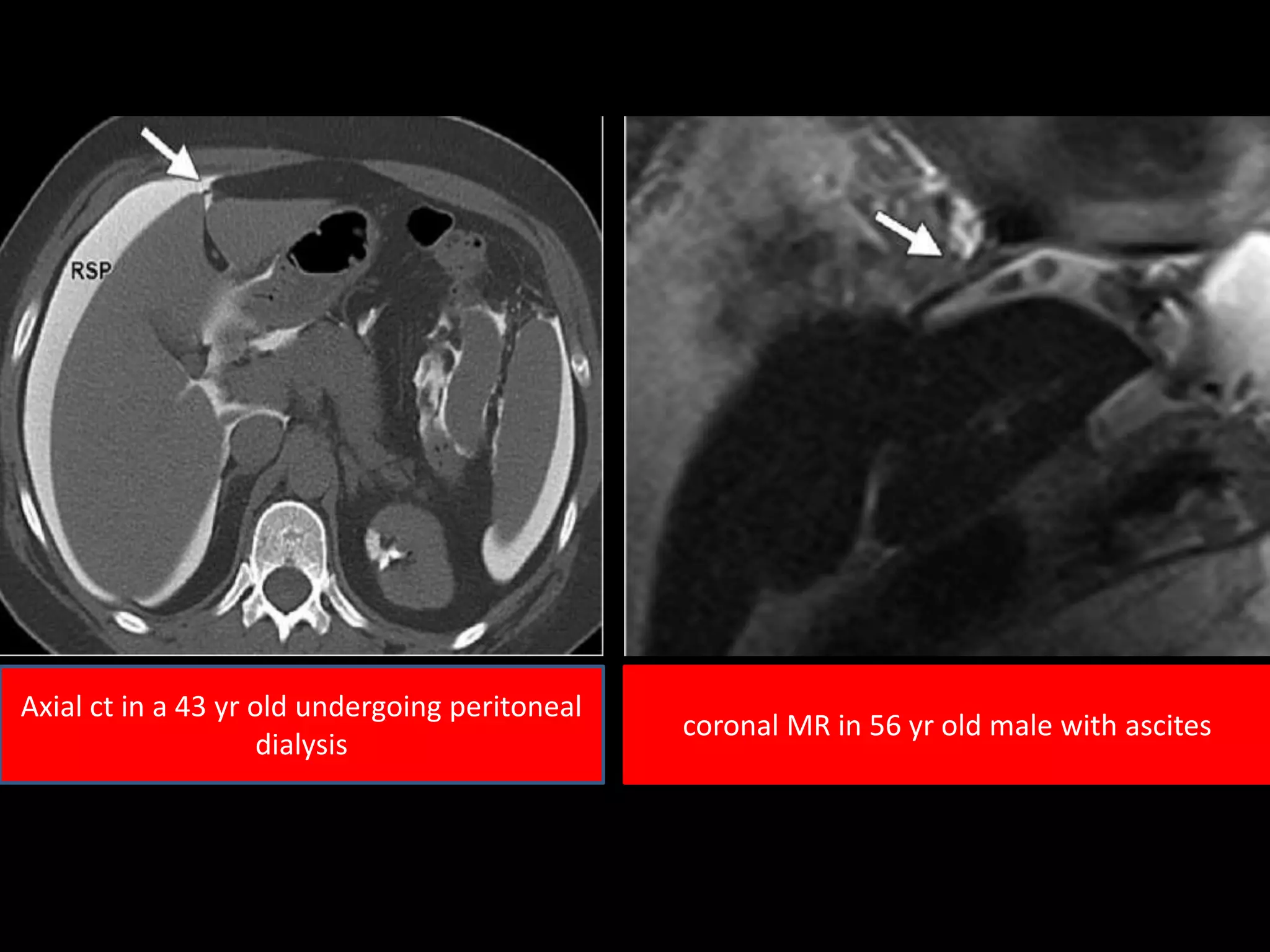 Axial ct in a 43 yr old undergoing peritoneal
dialysis
coronal MR in 56 yr old male with ascites
 
