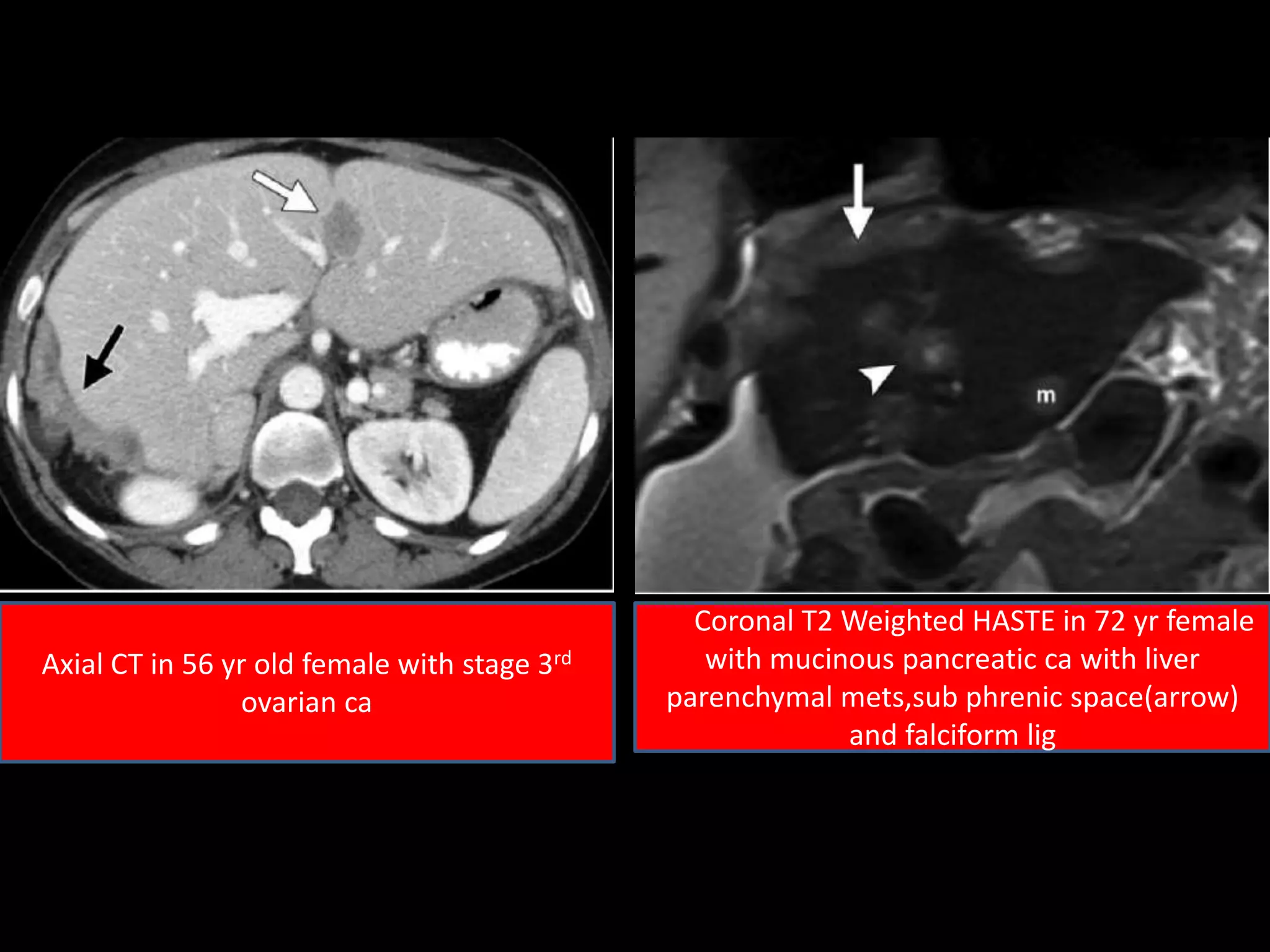 Axial CT in 56 yr old female with stage 3rd
ovarian ca
Coronal T2 Weighted HASTE in 72 yr female
with mucinous pancreatic ca with liver
parenchymal mets,sub phrenic space(arrow)
and falciform lig
 