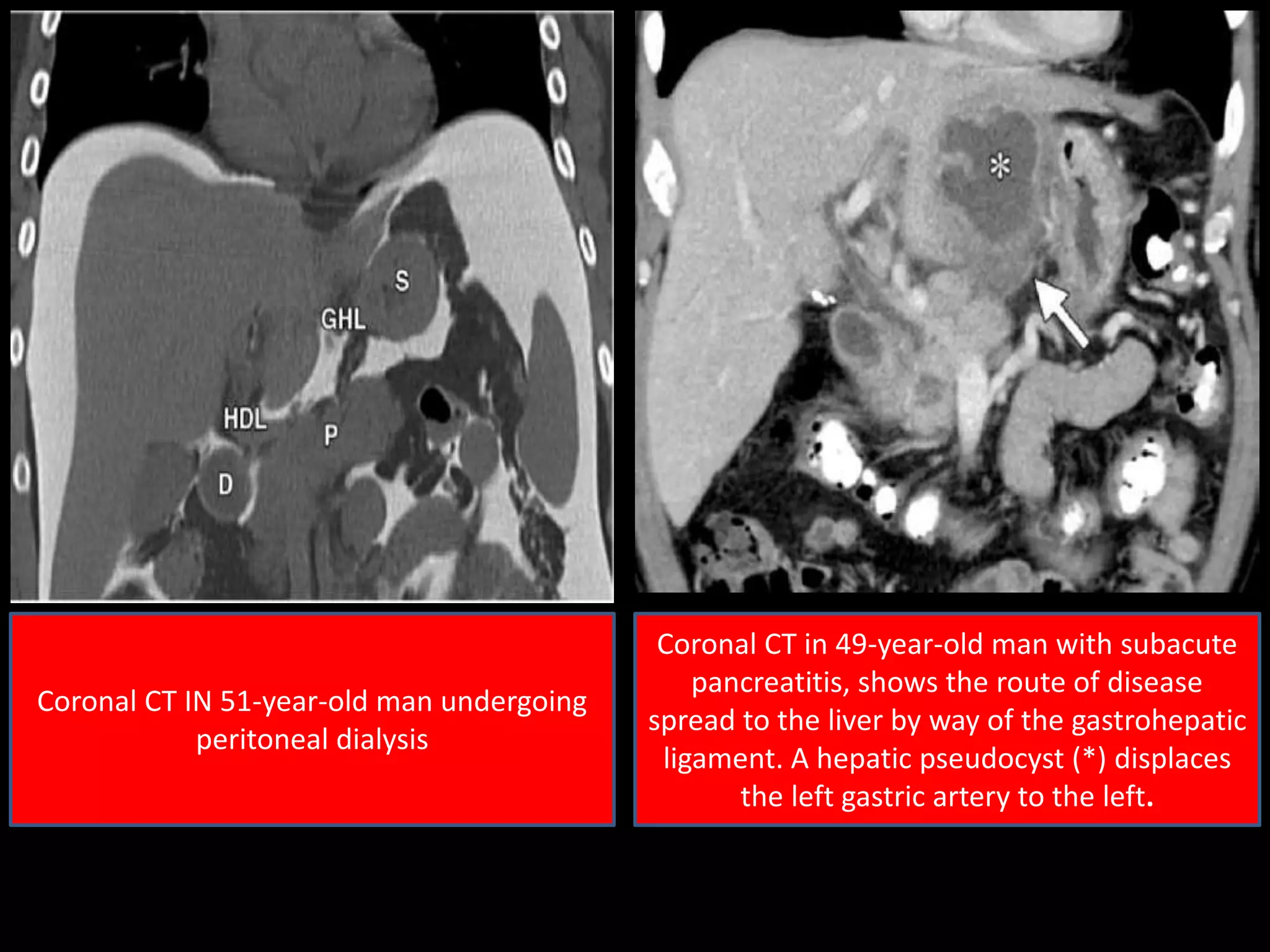 Coronal CT IN 51-year-old man undergoing
peritoneal dialysis
Coronal CT in 49-year-old man with subacute
pancreatitis, shows the route of disease
spread to the liver by way of the gastrohepatic
ligament. A hepatic pseudocyst (*) displaces
the left gastric artery to the left.
 