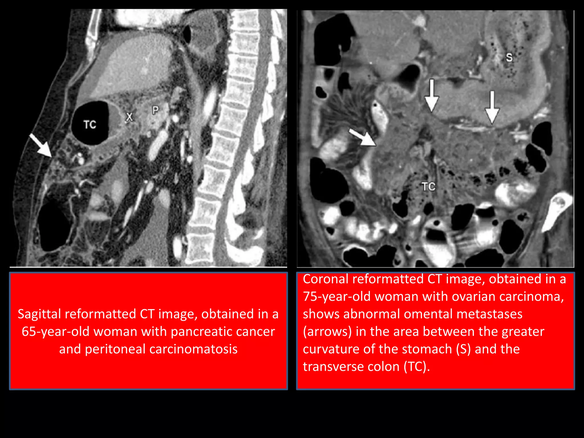 Sagittal reformatted CT image, obtained in a
65-year-old woman with pancreatic cancer
and peritoneal carcinomatosis
Coronal reformatted CT image, obtained in a
75-year-old woman with ovarian carcinoma,
shows abnormal omental metastases
(arrows) in the area between the greater
curvature of the stomach (S) and the
transverse colon (TC).
 