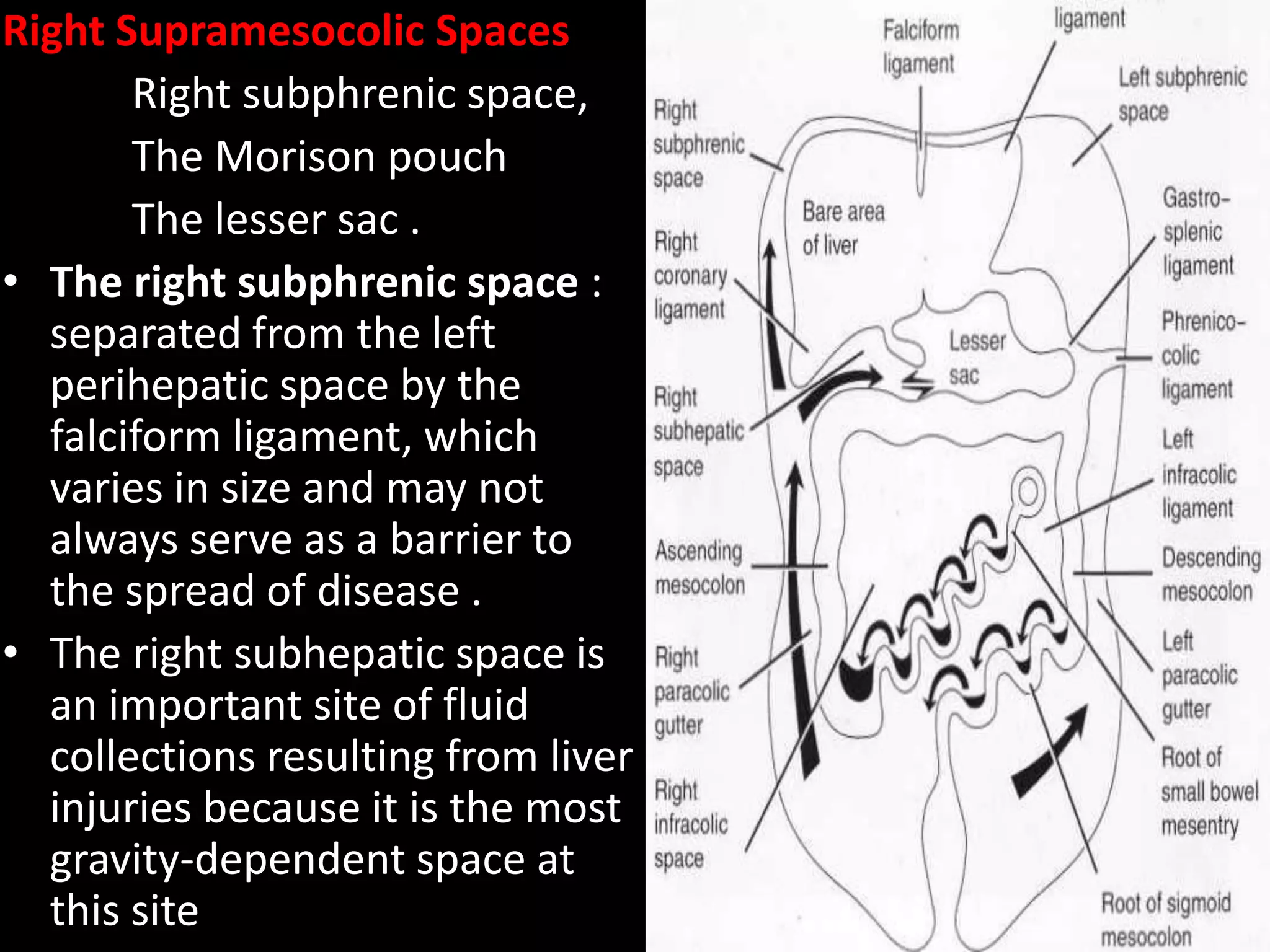 Right Supramesocolic Spaces
Right subphrenic space,
The Morison pouch
The lesser sac .
• The right subphrenic space :
separated from the left
perihepatic space by the
falciform ligament, which
varies in size and may not
always serve as a barrier to
the spread of disease .
• The right subhepatic space is
an important site of fluid
collections resulting from liver
injuries because it is the most
gravity-dependent space at
this site
 
