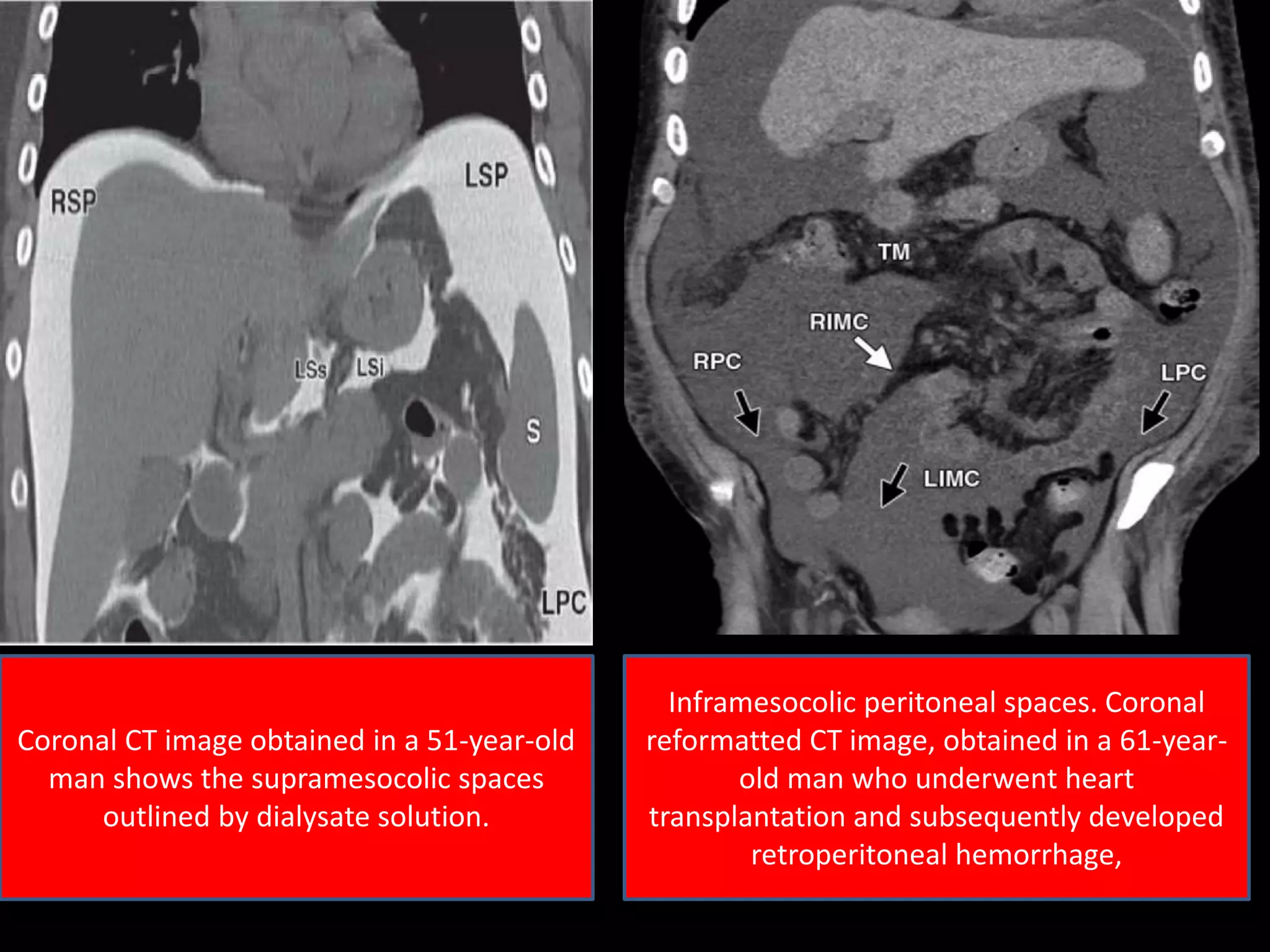 Coronal CT image obtained in a 51-year-old
man shows the supramesocolic spaces
outlined by dialysate solution.
Inframesocolic peritoneal spaces. Coronal
reformatted CT image, obtained in a 61-year-
old man who underwent heart
transplantation and subsequently developed
retroperitoneal hemorrhage,
 
