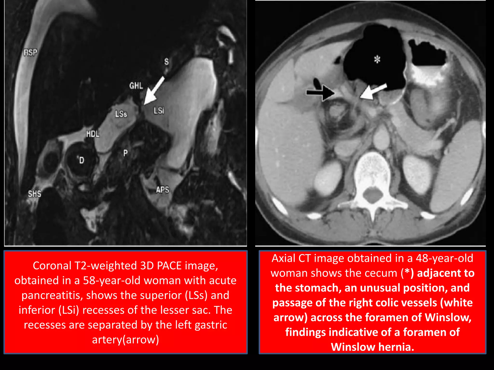 Coronal T2-weighted 3D PACE image,
obtained in a 58-year-old woman with acute
pancreatitis, shows the superior (LSs) and
inferior (LSi) recesses of the lesser sac. The
recesses are separated by the left gastric
artery(arrow)
Axial CT image obtained in a 48-year-old
woman shows the cecum (*) adjacent to
the stomach, an unusual position, and
passage of the right colic vessels (white
arrow) across the foramen of Winslow,
findings indicative of a foramen of
Winslow hernia.
 