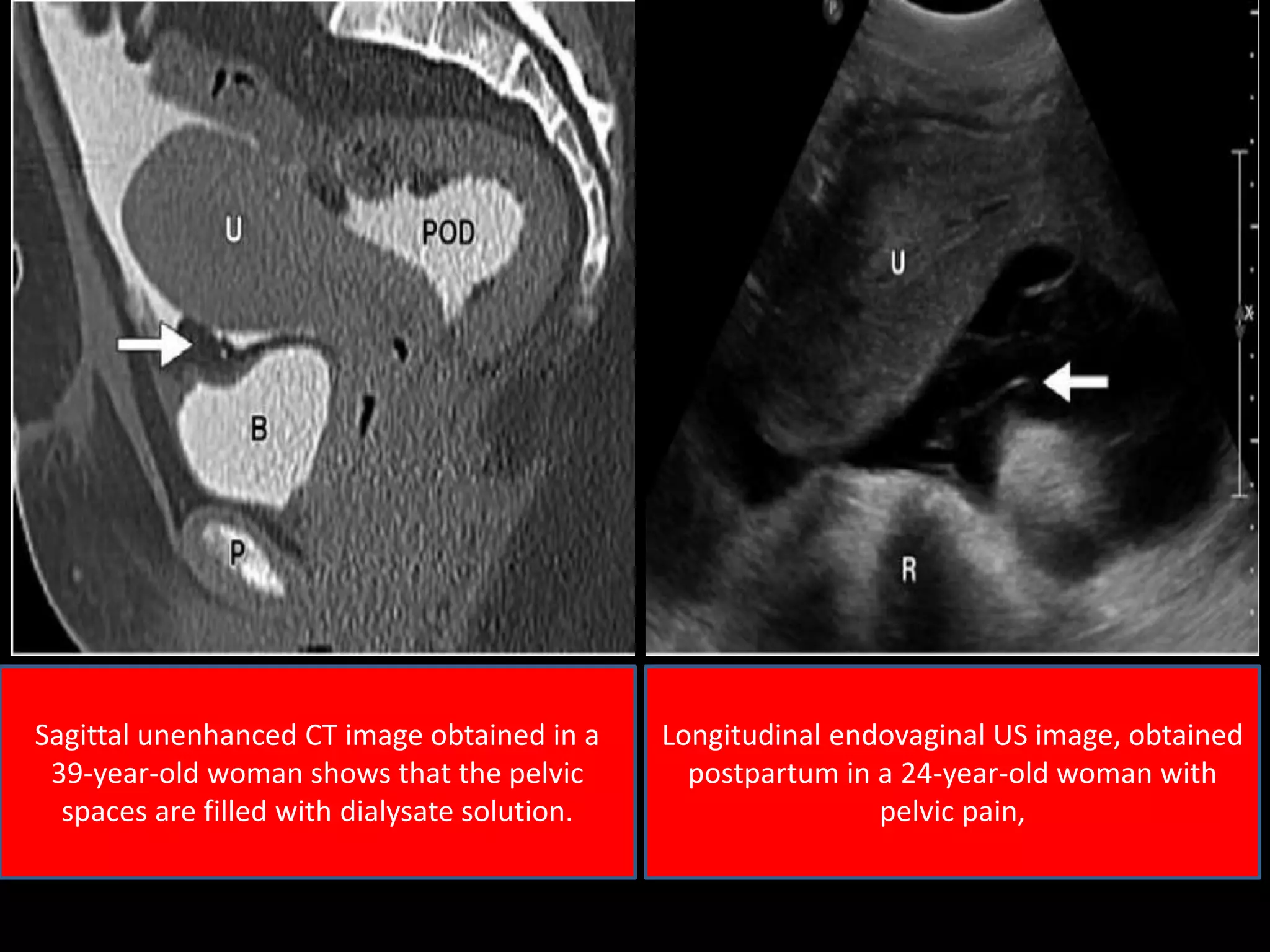 Sagittal unenhanced CT image obtained in a
39-year-old woman shows that the pelvic
spaces are filled with dialysate solution.
Longitudinal endovaginal US image, obtained
postpartum in a 24-year-old woman with
pelvic pain,
 