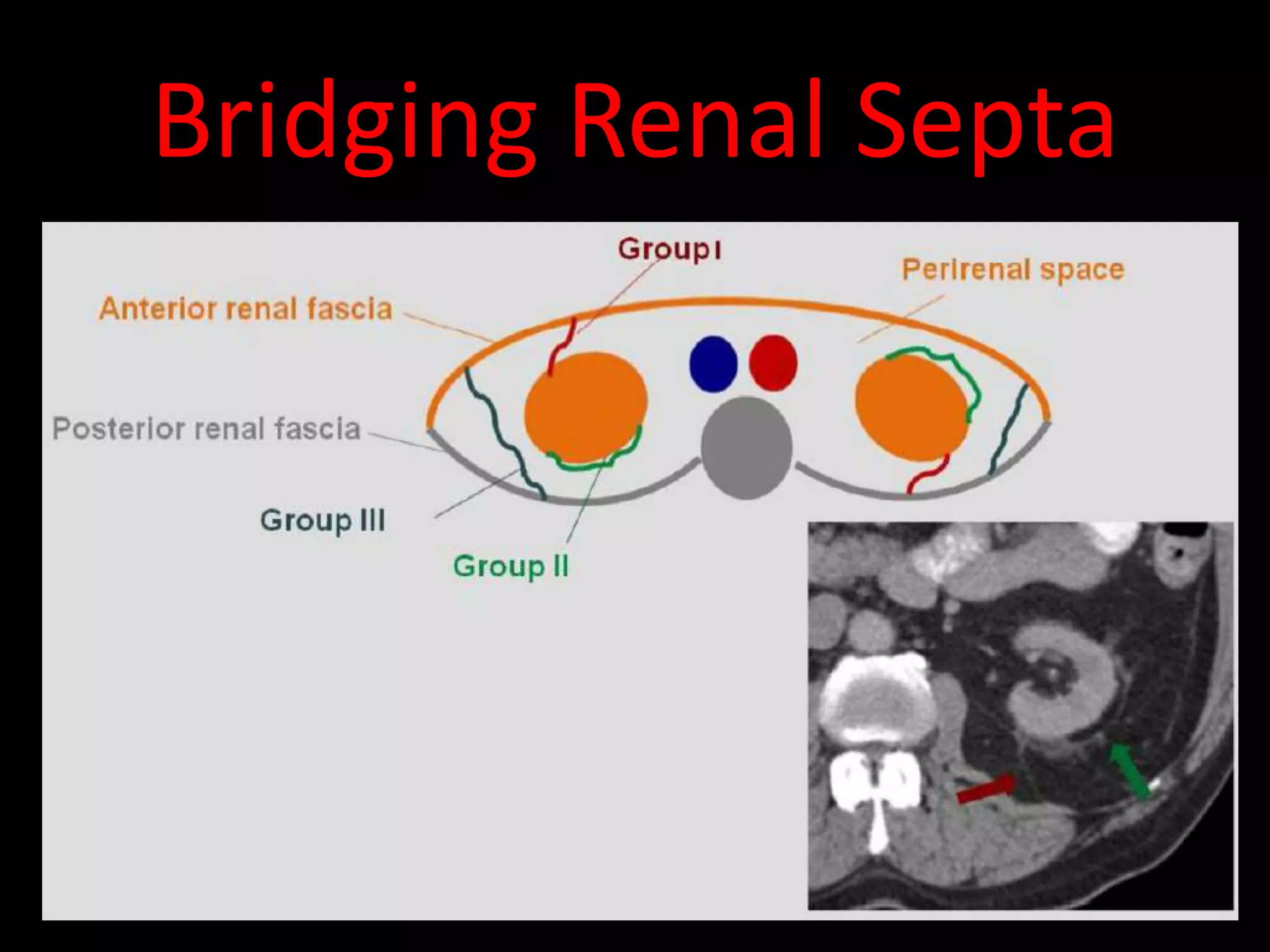 Bridging Renal Septa
 