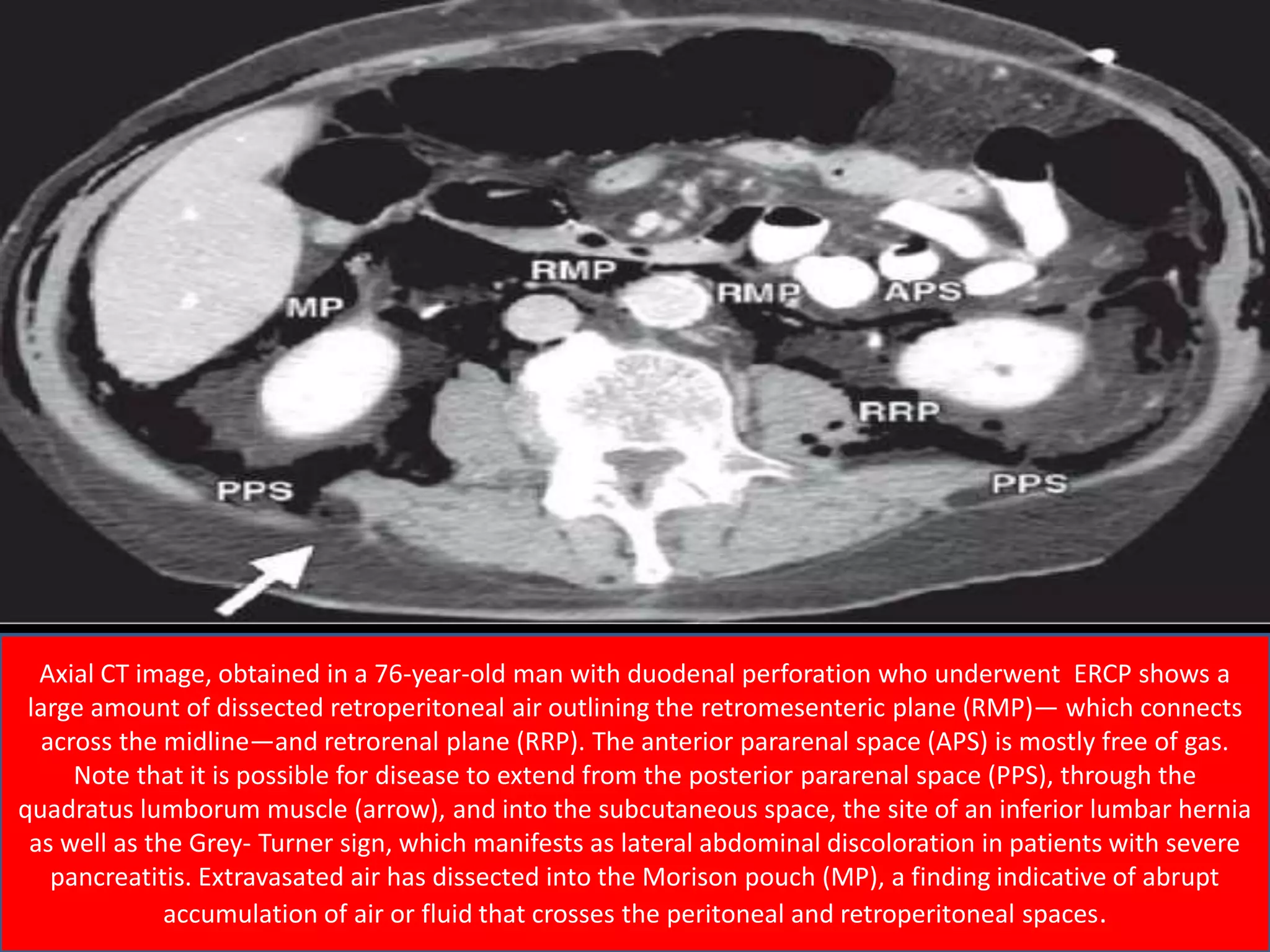 Axial CT image, obtained in a 76-year-old man with duodenal perforation who underwent ERCP shows a
large amount of dissected retroperitoneal air outlining the retromesenteric plane (RMP)— which connects
across the midline—and retrorenal plane (RRP). The anterior pararenal space (APS) is mostly free of gas.
Note that it is possible for disease to extend from the posterior pararenal space (PPS), through the
quadratus lumborum muscle (arrow), and into the subcutaneous space, the site of an inferior lumbar hernia
as well as the Grey- Turner sign, which manifests as lateral abdominal discoloration in patients with severe
pancreatitis. Extravasated air has dissected into the Morison pouch (MP), a finding indicative of abrupt
accumulation of air or fluid that crosses the peritoneal and retroperitoneal spaces.
 