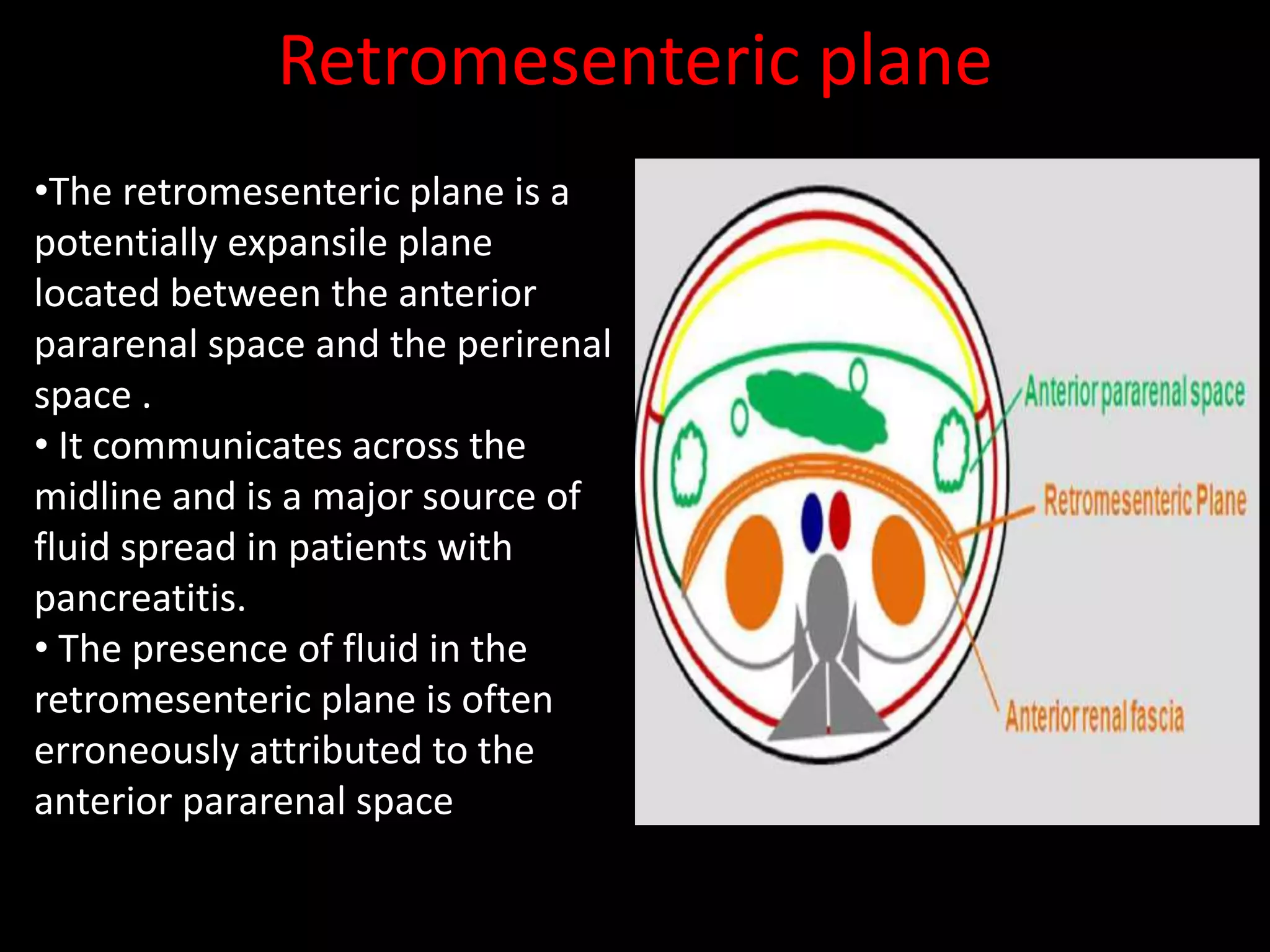 Retromesenteric plane
•The retromesenteric plane is a
potentially expansile plane
located between the anterior
pararenal space and the perirenal
space .
• It communicates across the
midline and is a major source of
fluid spread in patients with
pancreatitis.
• The presence of fluid in the
retromesenteric plane is often
erroneously attributed to the
anterior pararenal space
 
