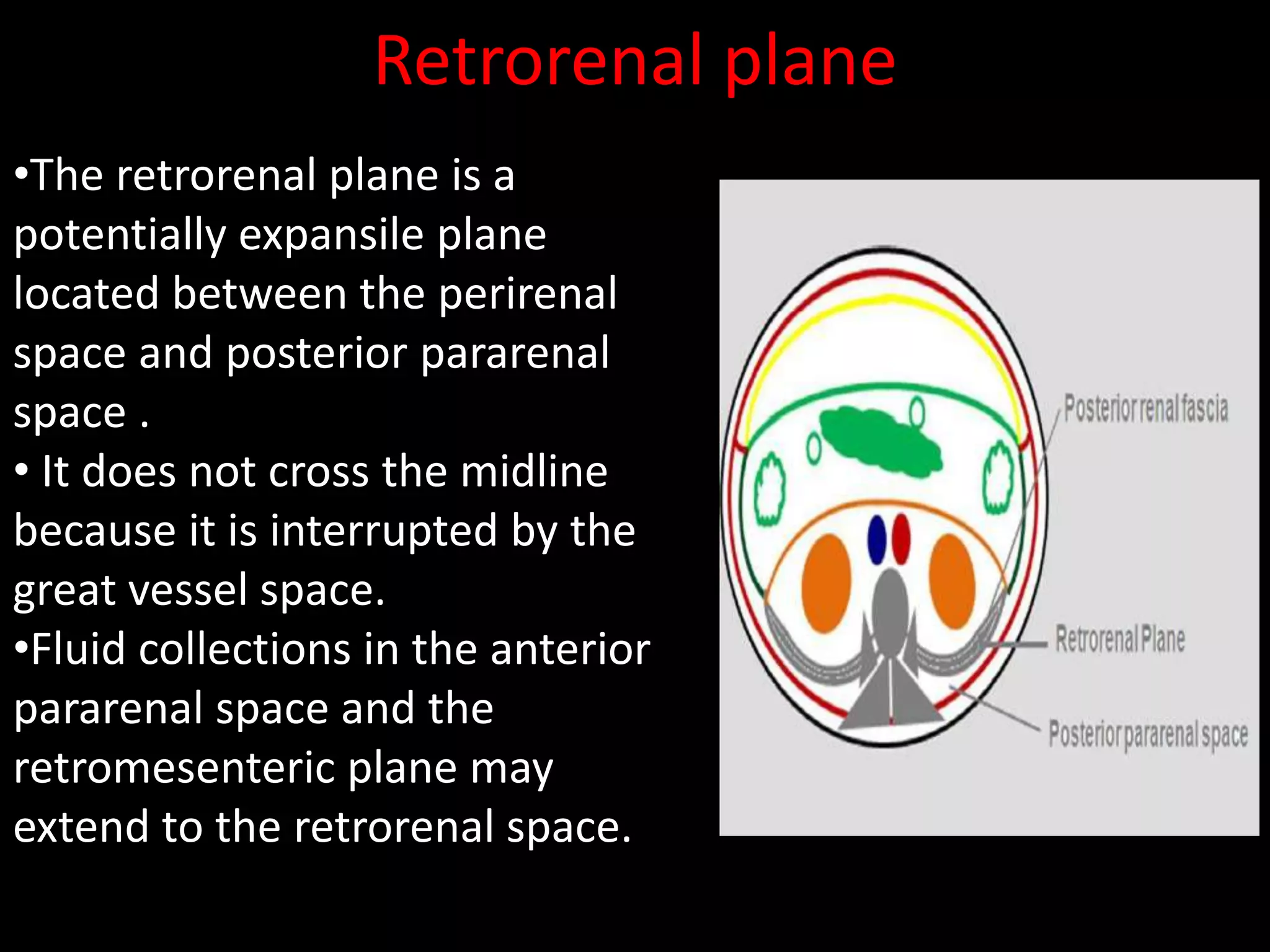 Retrorenal plane
•The retrorenal plane is a
potentially expansile plane
located between the perirenal
space and posterior pararenal
space .
• It does not cross the midline
because it is interrupted by the
great vessel space.
•Fluid collections in the anterior
pararenal space and the
retromesenteric plane may
extend to the retrorenal space.
 