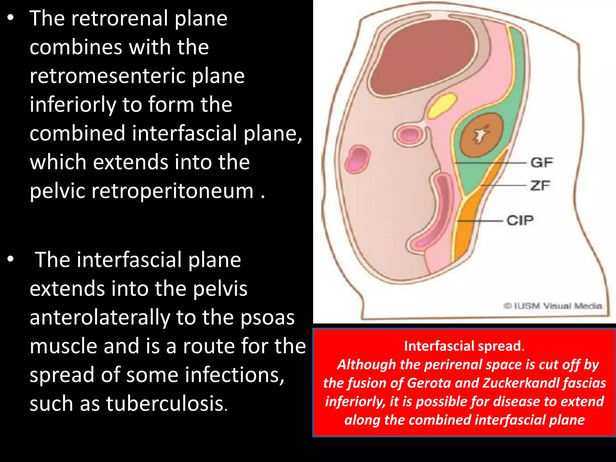 • The retrorenal plane
combines with the
retromesenteric plane
inferiorly to form the
combined interfascial plane,
which extends into the
pelvic retroperitoneum .
• The interfascial plane
extends into the pelvis
anterolaterally to the psoas
muscle and is a route for the
spread of some infections,
such as tuberculosis.
Interfascial spread.
Although the perirenal space is cut off by
the fusion of Gerota and Zuckerkandl fascias
inferiorly, it is possible for disease to extend
along the combined interfascial plane
 