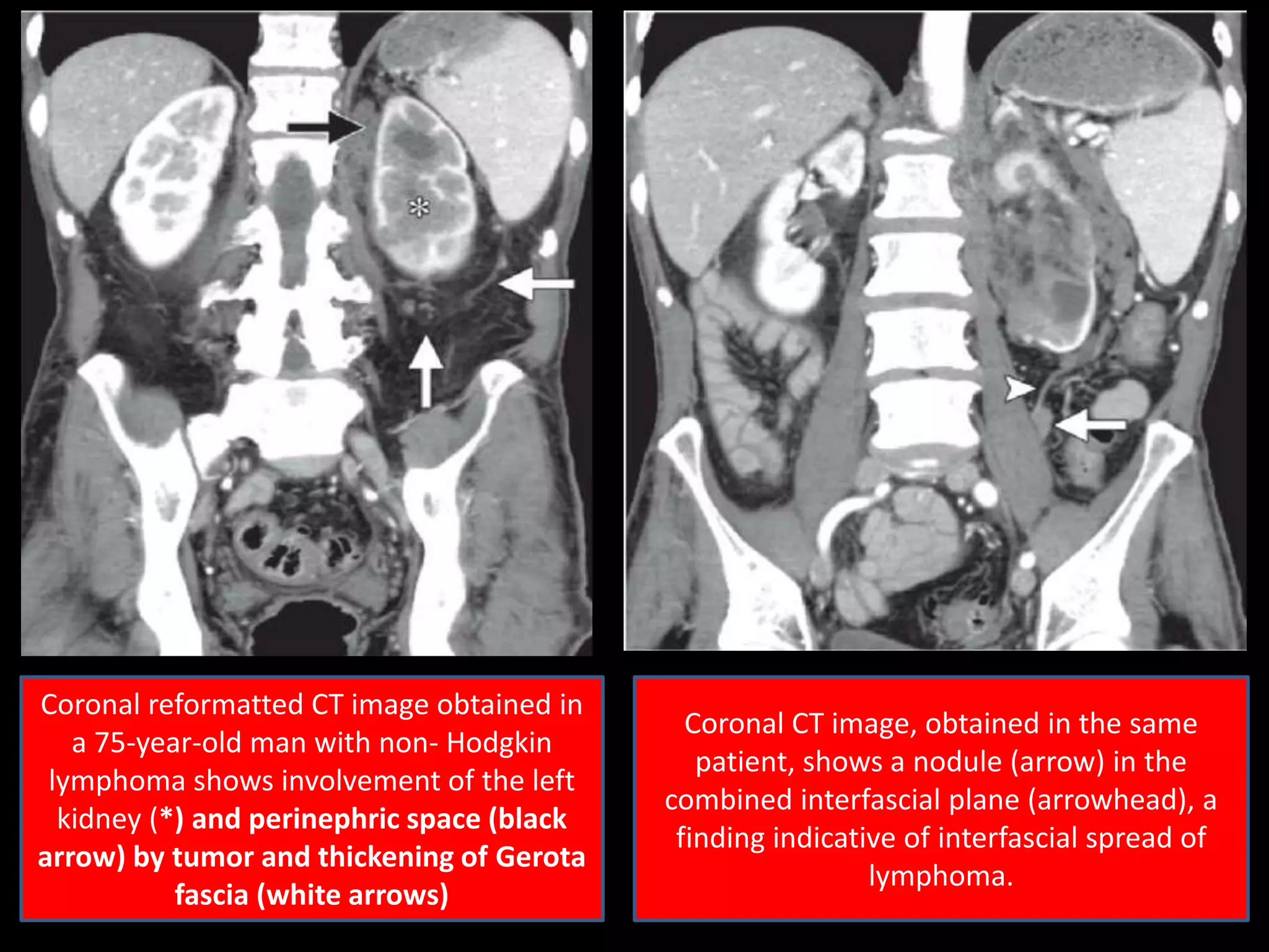 Coronal reformatted CT image obtained in
a 75-year-old man with non- Hodgkin
lymphoma shows involvement of the left
kidney (*) and perinephric space (black
arrow) by tumor and thickening of Gerota
fascia (white arrows)
Coronal CT image, obtained in the same
patient, shows a nodule (arrow) in the
combined interfascial plane (arrowhead), a
finding indicative of interfascial spread of
lymphoma.
 