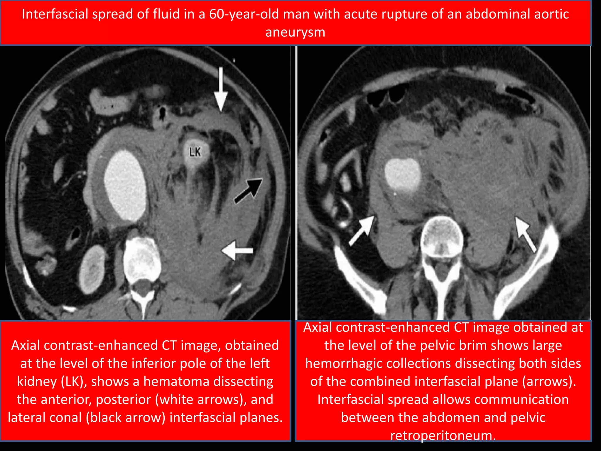 Axial contrast-enhanced CT image, obtained
at the level of the inferior pole of the left
kidney (LK), shows a hematoma dissecting
the anterior, posterior (white arrows), and
lateral conal (black arrow) interfascial planes.
Axial contrast-enhanced CT image obtained at
the level of the pelvic brim shows large
hemorrhagic collections dissecting both sides
of the combined interfascial plane (arrows).
Interfascial spread allows communication
between the abdomen and pelvic
retroperitoneum.
Interfascial spread of fluid in a 60-year-old man with acute rupture of an abdominal aortic
aneurysm
 