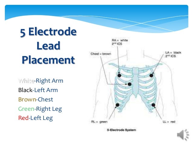 Placement telemetry monitoring lead What is