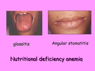 Nutritional deficiency anemia Angular stomatitis glossitis 