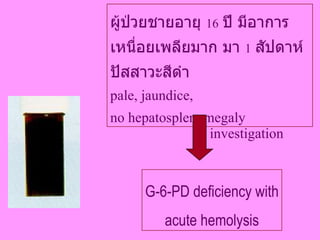ผู้ป่วยชายอายุ  16   ปี มีอาการเหนื่อยเพลียมาก มา  1   สัปดาห์ ปัสสาวะสีดำ pale, jaundice,  no hepatosplenomegaly G-6-PD deficiency with acute hemolysis investigation 