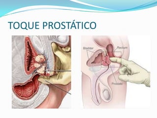 TOQUE PROSTÁTICO
 