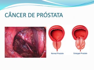 CÂNCER DE PRÓSTATA
 