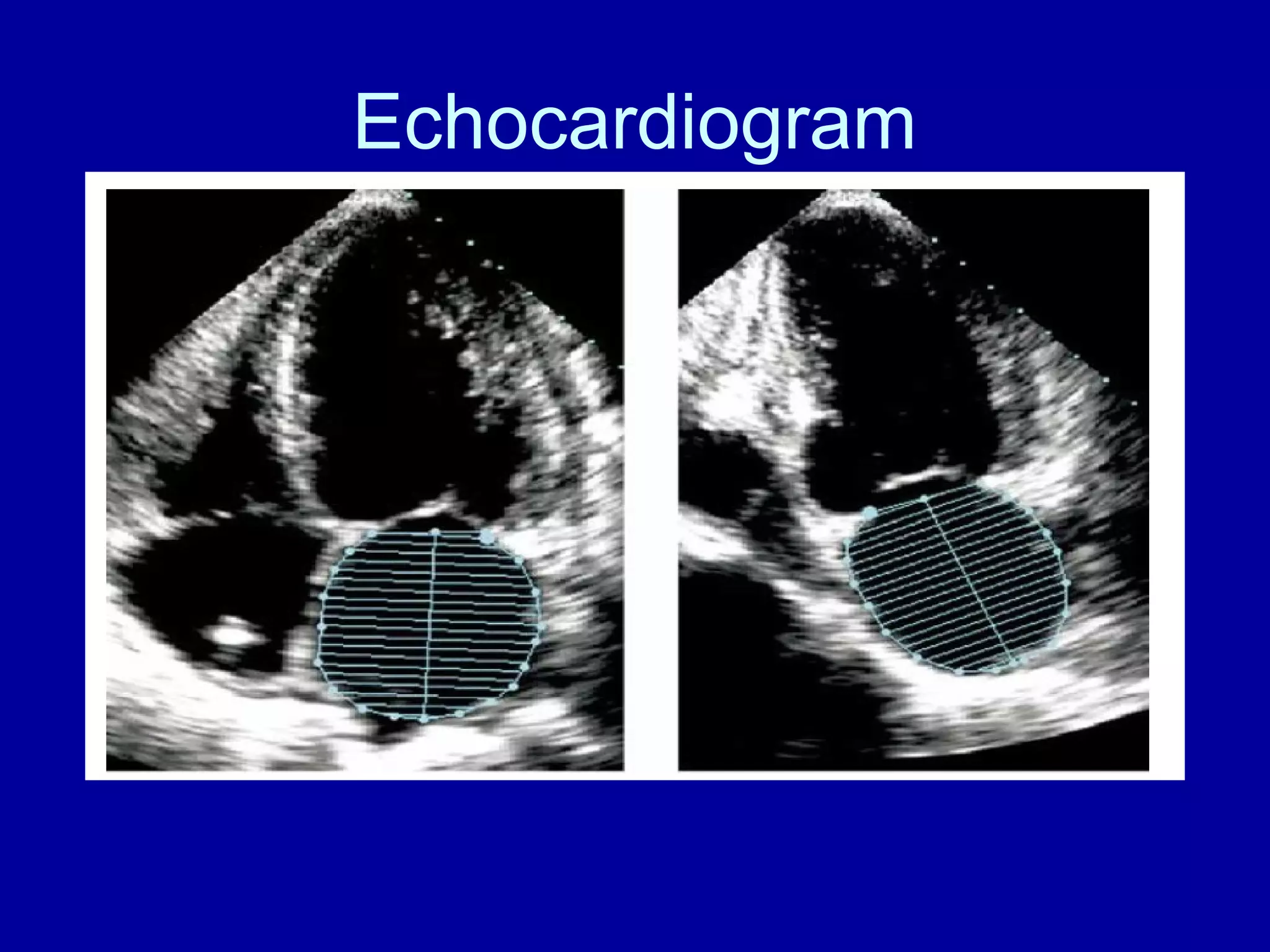 Echocardiogram 
 