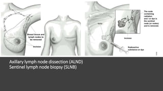 breast cancer | PPTX