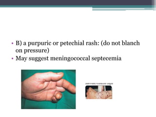 • B) a purpuric or petechial rash: (do not blanch
on pressure)
• May suggest meningococcal septecemia
 