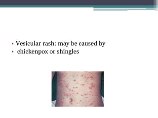 • Vesicular rash: may be caused by
• chickenpox or shingles
 