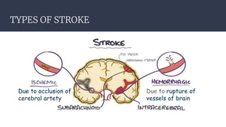 TYPES OF STROKE
Due to occlusion of
cerebral artety
Due to rupture of
vessels of brain
 