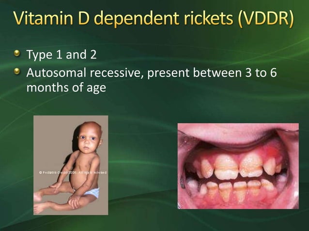 Approach to childhood rickets | PPTX