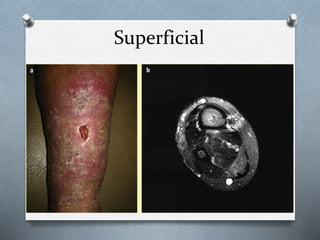 Superficial
 