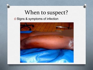 When to suspect?
O Signs & symptoms of infection
 
