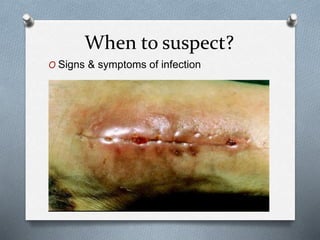When to suspect?
O Signs & symptoms of infection
 