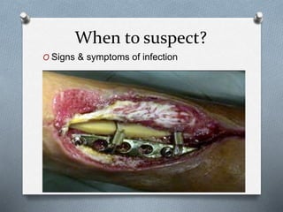 When to suspect?
O Signs & symptoms of infection
 
