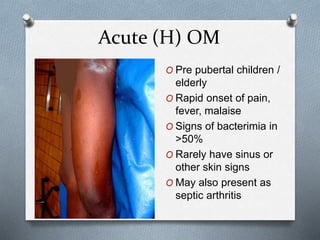 Acute (H) OM
O Pre pubertal children /
elderly
O Rapid onset of pain,
fever, malaise
O Signs of bacterimia in
>50%
O Rarely have sinus or
other skin signs
O May also present as
septic arthritis
 