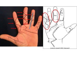 Racket Incision Hand Hand incision Approaches ortho plastic.ppt