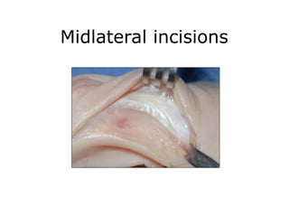 Racket Incision Hand Hand incision Approaches ortho plastic.ppt