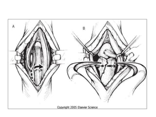 Hand incision Approaches ortho plastic.ppt