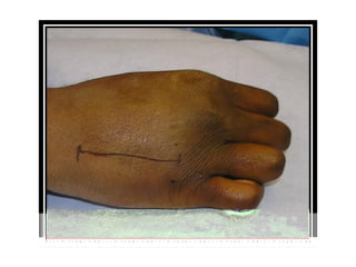 Hand incision Approaches ortho plastic.ppt