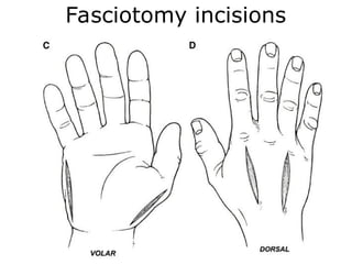 Racket Incision Hand Hand incision Approaches ortho plastic.ppt