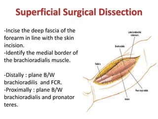 Superficial Surgical Dissection
-Incise the deep fascia of the
forearm in line with the skin
incision.
-Identify the medial border of
the brachioradialis muscle.
-Distally : plane B/W
brachioradilis and FCR.
-Proximally : plane B/W
brachioradialis and pronator
teres.
 