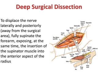 To displace the nerve
laterally and posteriorly
(away from the surgical
area), fully supinate the
forearm, exposing, at the
same time, the insertion of
the supinator muscle into
the anterior aspect of the
radius
Deep Surgical Dissection
 