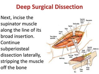 Next, incise the
supinator muscle
along the line of its
broad insertion.
Continue
subperiosteal
dissection laterally,
stripping the muscle
off the bone
Deep Surgical Dissection
 