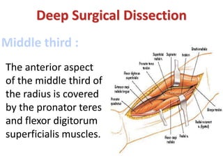 Middle third :
Deep Surgical Dissection
The anterior aspect
of the middle third of
the radius is covered
by the pronator teres
and flexor digitorum
superficialis muscles.
 