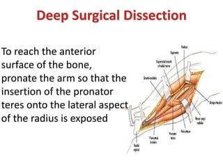 Deep Surgical Dissection
To reach the anterior
surface of the bone,
pronate the arm so that the
insertion of the pronator
teres onto the lateral aspect
of the radius is exposed
 