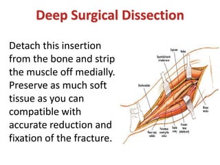 Detach this insertion
from the bone and strip
the muscle off medially.
Preserve as much soft
tissue as you can
compatible with
accurate reduction and
fixation of the fracture.
Deep Surgical Dissection
 