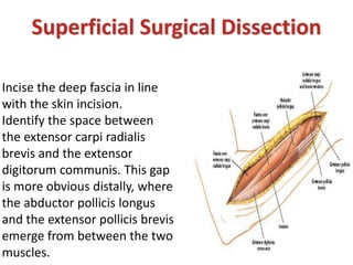Superficial Surgical Dissection
Incise the deep fascia in line
with the skin incision.
Identify the space between
the extensor carpi radialis
brevis and the extensor
digitorum communis. This gap
is more obvious distally, where
the abductor pollicis longus
and the extensor pollicis brevis
emerge from between the two
muscles.
 
