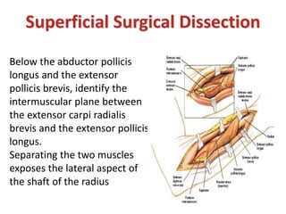 Below the abductor pollicis
longus and the extensor
pollicis brevis, identify the
intermuscular plane between
the extensor carpi radialis
brevis and the extensor pollicis
longus.
Separating the two muscles
exposes the lateral aspect of
the shaft of the radius
Superficial Surgical Dissection
 